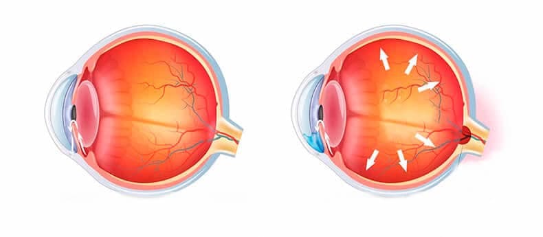 Ocular Disease Classification (CNN)